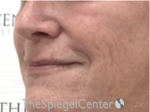 Lip Lift Before & After Gallery - Patient 323969 - Image 3