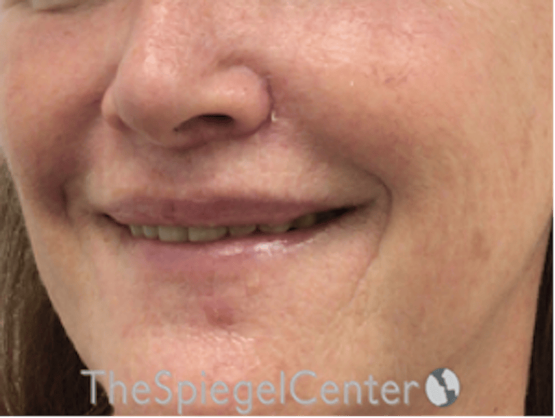 Lip Lift Before & After Gallery - Patient 323969 - Image 4