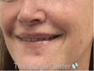 Lip Lift Before & After Gallery - Patient 323969 - Image 4