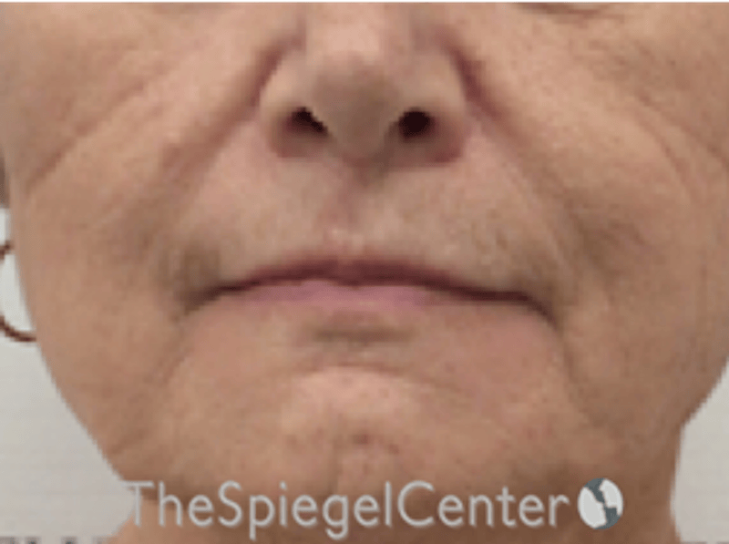 Lip Lift Before & After Gallery - Patient 237337 - Image 1