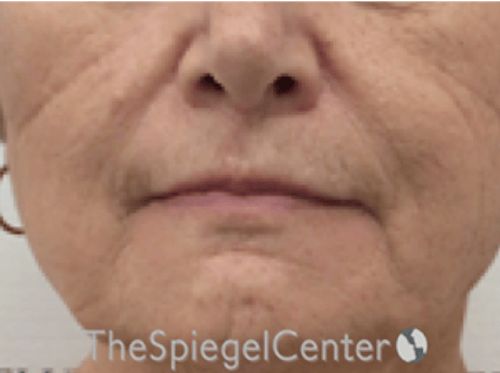 Lip Lift Before & After Gallery - Patient 237337 - Image 1