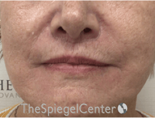 Lip Lift Before & After Gallery - Patient 237337 - Image 2