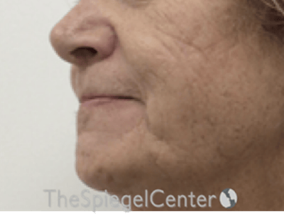 Lip Lift Before & After Gallery - Patient 237337 - Image 3