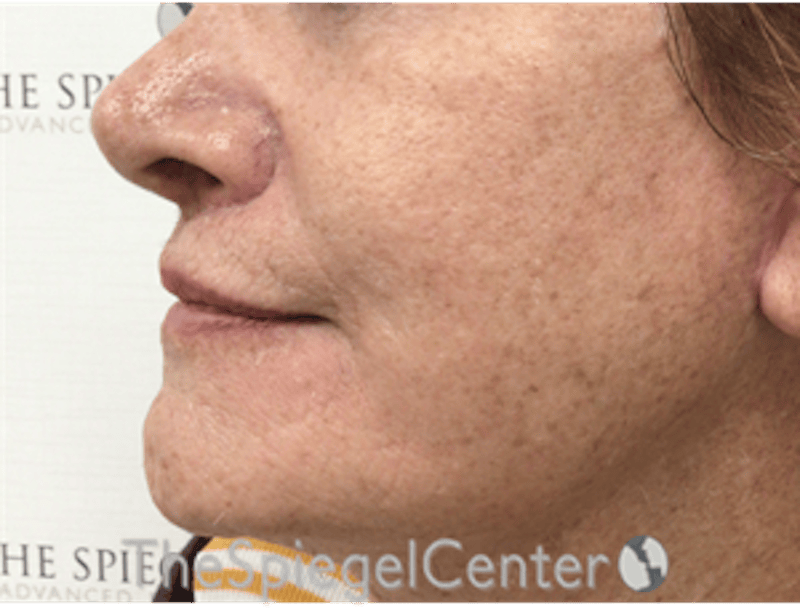 Lip Lift Before & After Gallery - Patient 237337 - Image 4