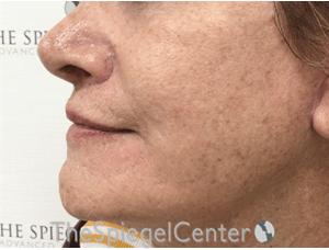 Lip Lift Before & After Gallery - Patient 237337 - Image 4