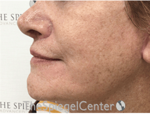 Lip Lift Before & After Gallery - Patient 237337 - Image 4
