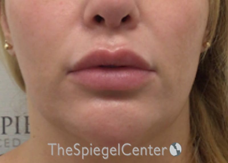 Lip Lift Before & After Gallery - Patient 394421 - Image 1