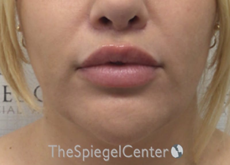 Lip Lift Before & After Gallery - Patient 394421 - Image 2