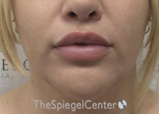 Lip Lift Before & After Gallery - Patient 394421 - Image 2