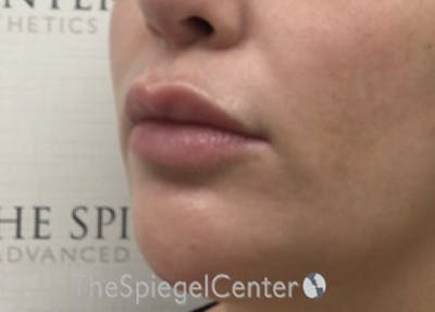 Lip Lift Before & After Gallery - Patient 394421 - Image 3