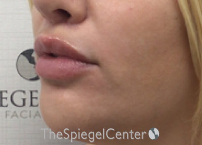 Lip Lift Before & After Gallery - Patient 394421 - Image 4