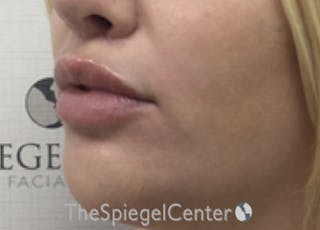 Lip Lift Before & After Gallery - Patient 394421 - Image 4