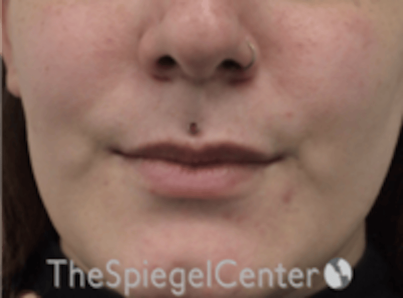Lip Lift Before & After Gallery - Patient 181802 - Image 1