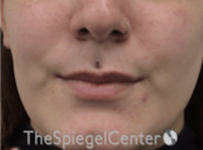 Lip Lift Before & After Gallery - Patient 181802 - Image 1
