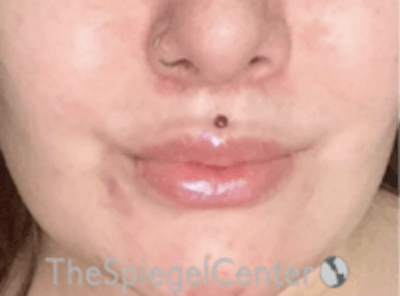 Lip Lift Before & After Gallery - Patient 181802 - Image 2