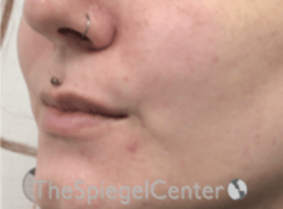 Lip Lift Before & After Gallery - Patient 181802 - Image 3