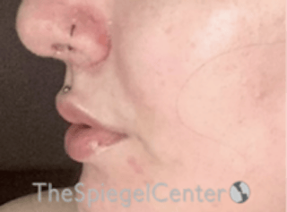 Lip Lift Before & After Gallery - Patient 181802 - Image 4