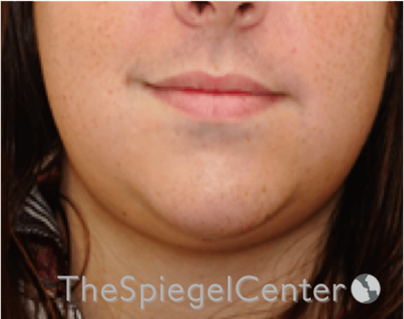 Lip Lift Before & After Gallery - Patient 369462 - Image 1