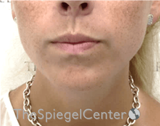 Lip Lift Before & After Gallery - Patient 369462 - Image 2