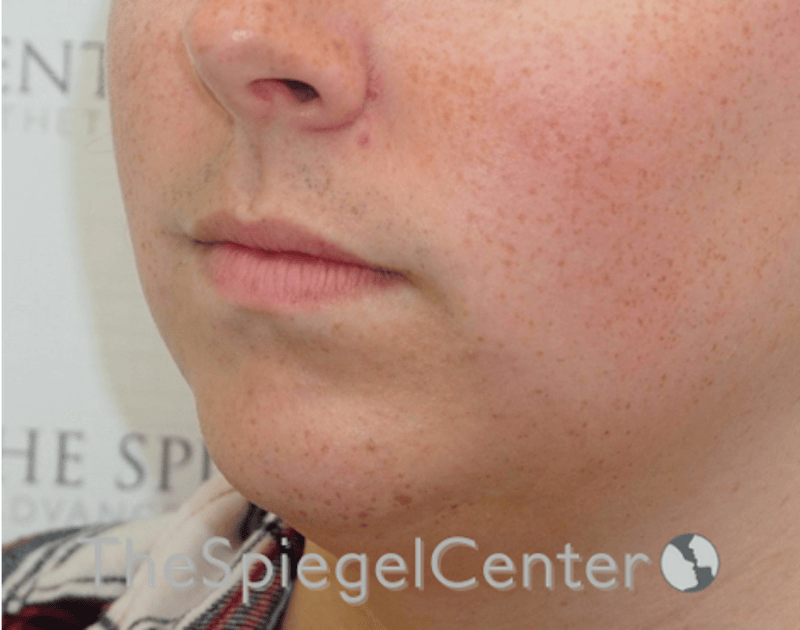 Lip Lift Before & After Gallery - Patient 369462 - Image 3