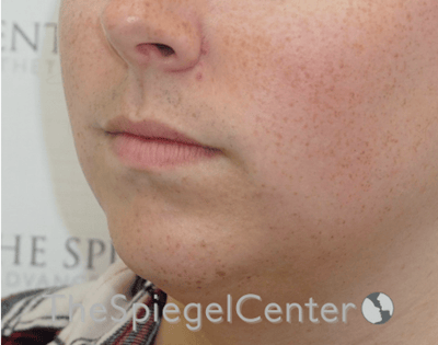 Lip Lift Before & After Gallery - Patient 369462 - Image 3