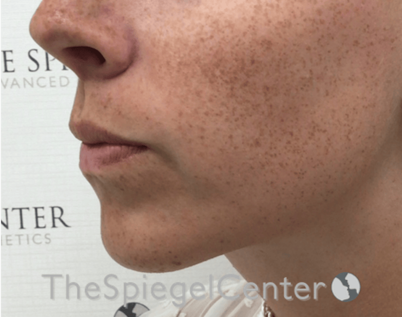 Lip Lift Before & After Gallery - Patient 369462 - Image 4