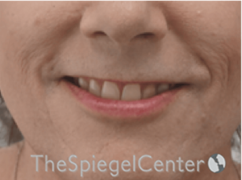 Lip Lift Before & After Gallery - Patient 325786 - Image 1