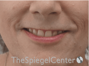 Lip Lift Before & After Gallery - Patient 325786 - Image 1
