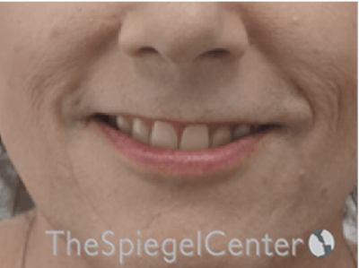 Lip Lift Before & After Gallery - Patient 325786 - Image 1