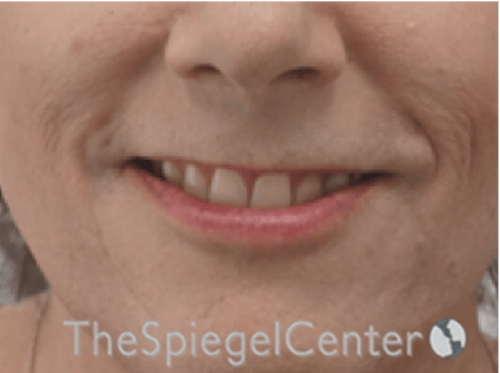 Lip Lift Before & After Gallery - Patient 325786 - Image 1