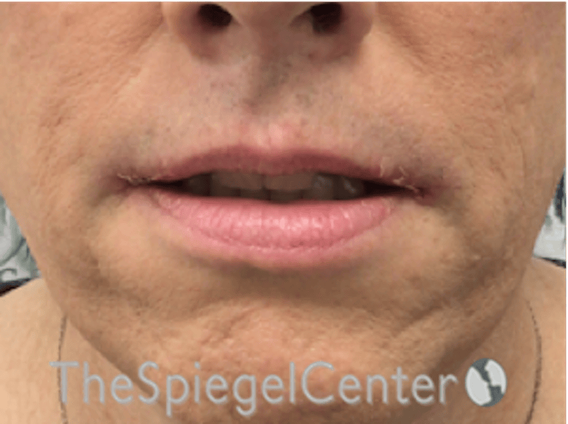 Lip Lift Before & After Gallery - Patient 325786 - Image 2