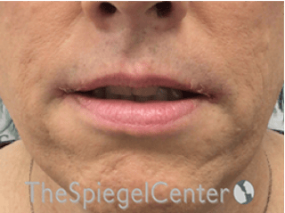 Lip Lift Before & After Gallery - Patient 325786 - Image 2