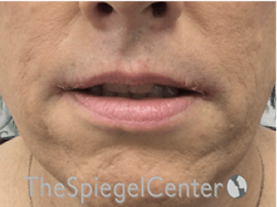Lip Lift Before & After Gallery - Patient 325786 - Image 2