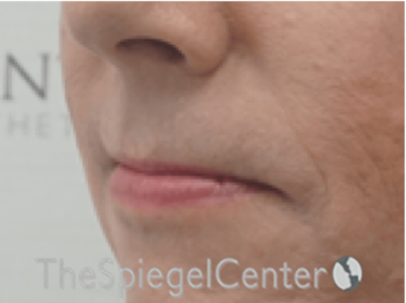 Lip Lift Before & After Gallery - Patient 325786 - Image 3