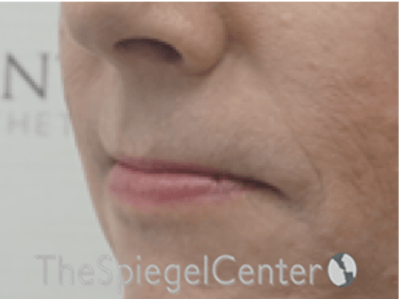 Lip Lift Before & After Gallery - Patient 325786 - Image 3