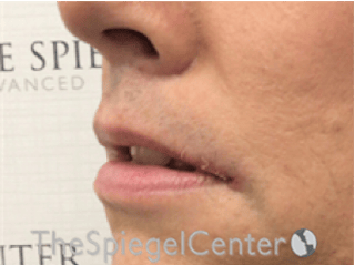 Lip Lift Before & After Gallery - Patient 325786 - Image 4
