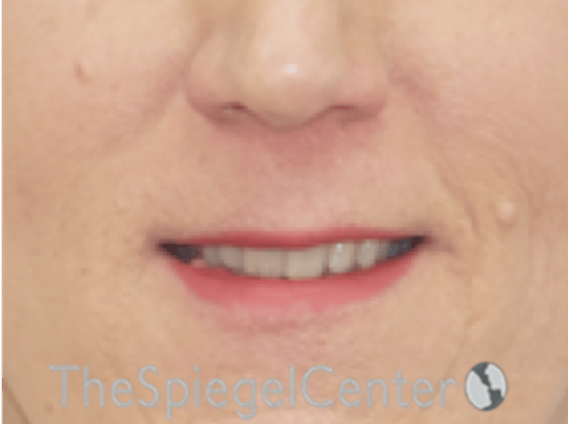 Lip Lift Before & After Gallery - Patient 163959 - Image 1
