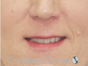 Lip Lift Before & After Gallery - Patient 163959 - Image 1