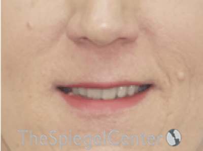 Lip Lift Before & After Gallery - Patient 163959 - Image 1