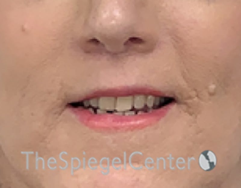 Lip Lift Before & After Gallery - Patient 163959 - Image 2