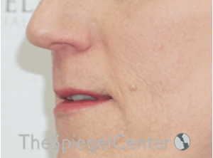 Lip Lift Before & After Gallery - Patient 163959 - Image 3