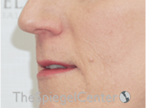 Lip Lift Before & After Gallery - Patient 163959 - Image 3