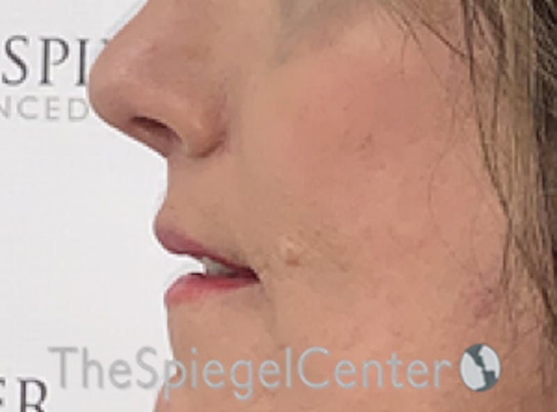 Lip Lift Before & After Gallery - Patient 163959 - Image 4