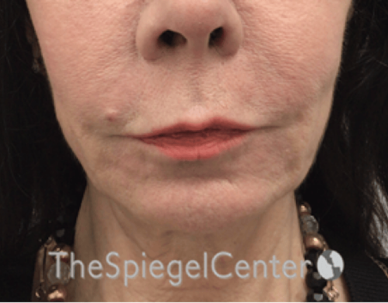 Lip Lift Before & After Gallery - Patient 327687 - Image 1