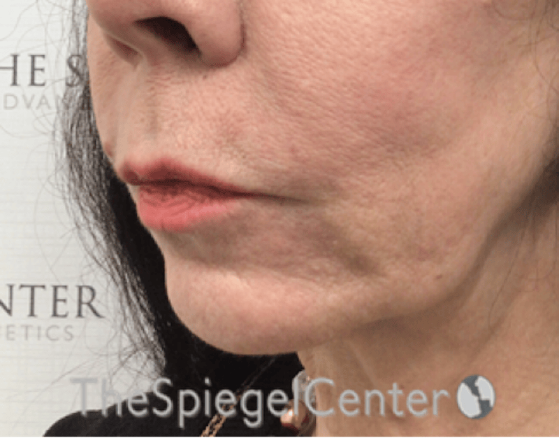 Lip Lift Before & After Gallery - Patient 327687 - Image 3
