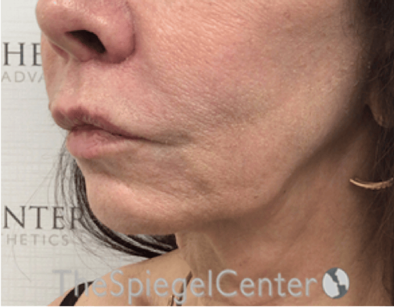 Lip Lift Before & After Gallery - Patient 327687 - Image 4