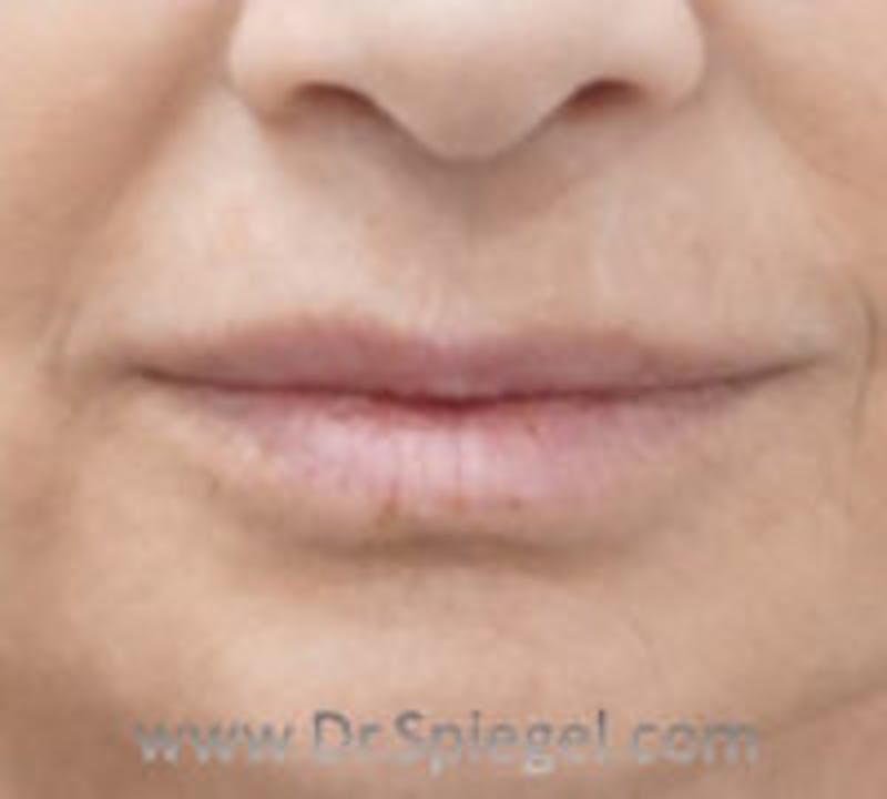Lip Lift Before & After Gallery - Patient 395563 - Image 1