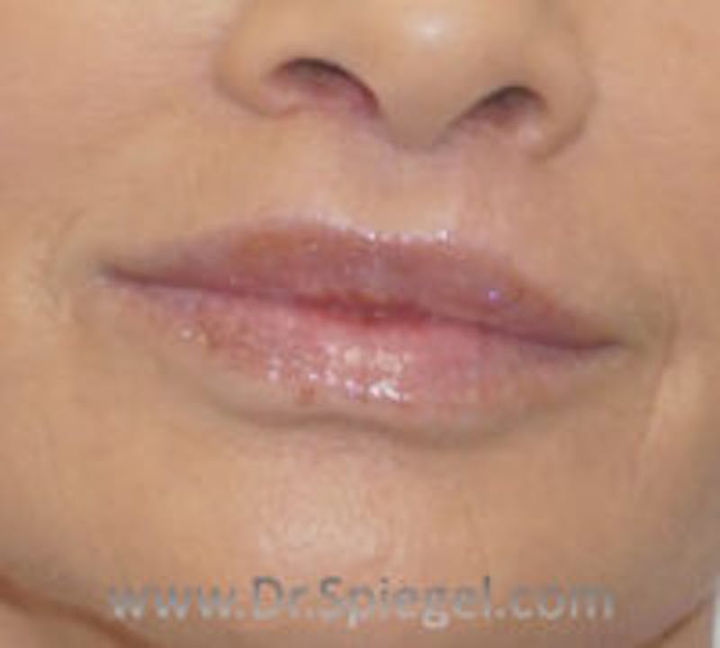 Lip Lift Before & After Gallery - Patient 395563 - Image 2