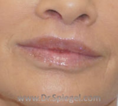 Lip Lift Before & After Gallery - Patient 395563 - Image 2