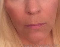 Lip Lift Before & After Gallery - Patient 386067 - Image 1